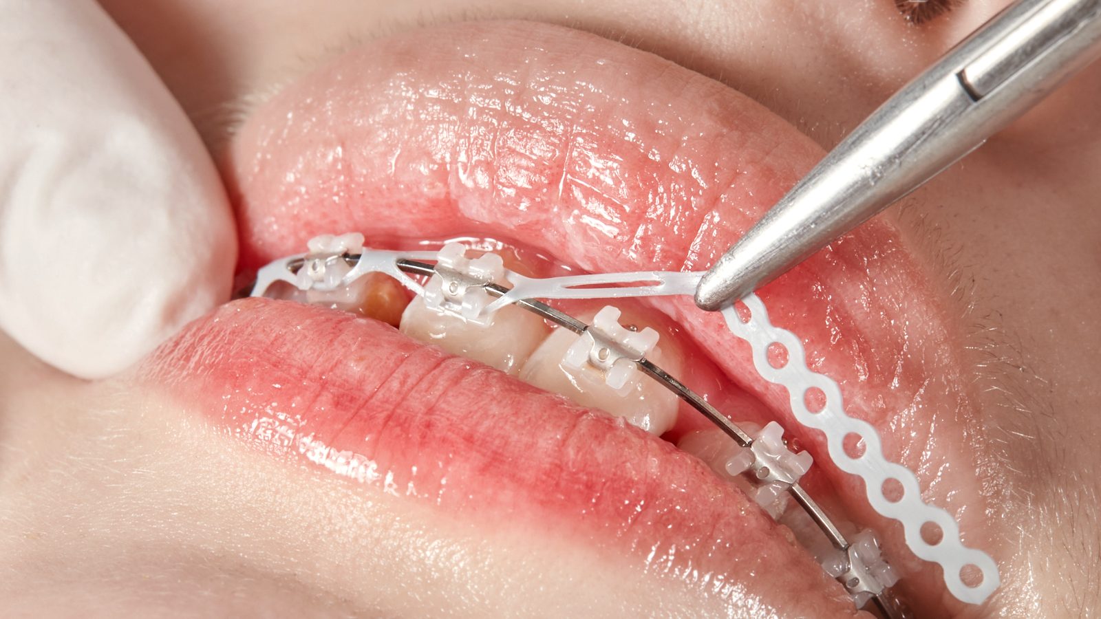 Attache collée sur une dent pour la traction orthodontique