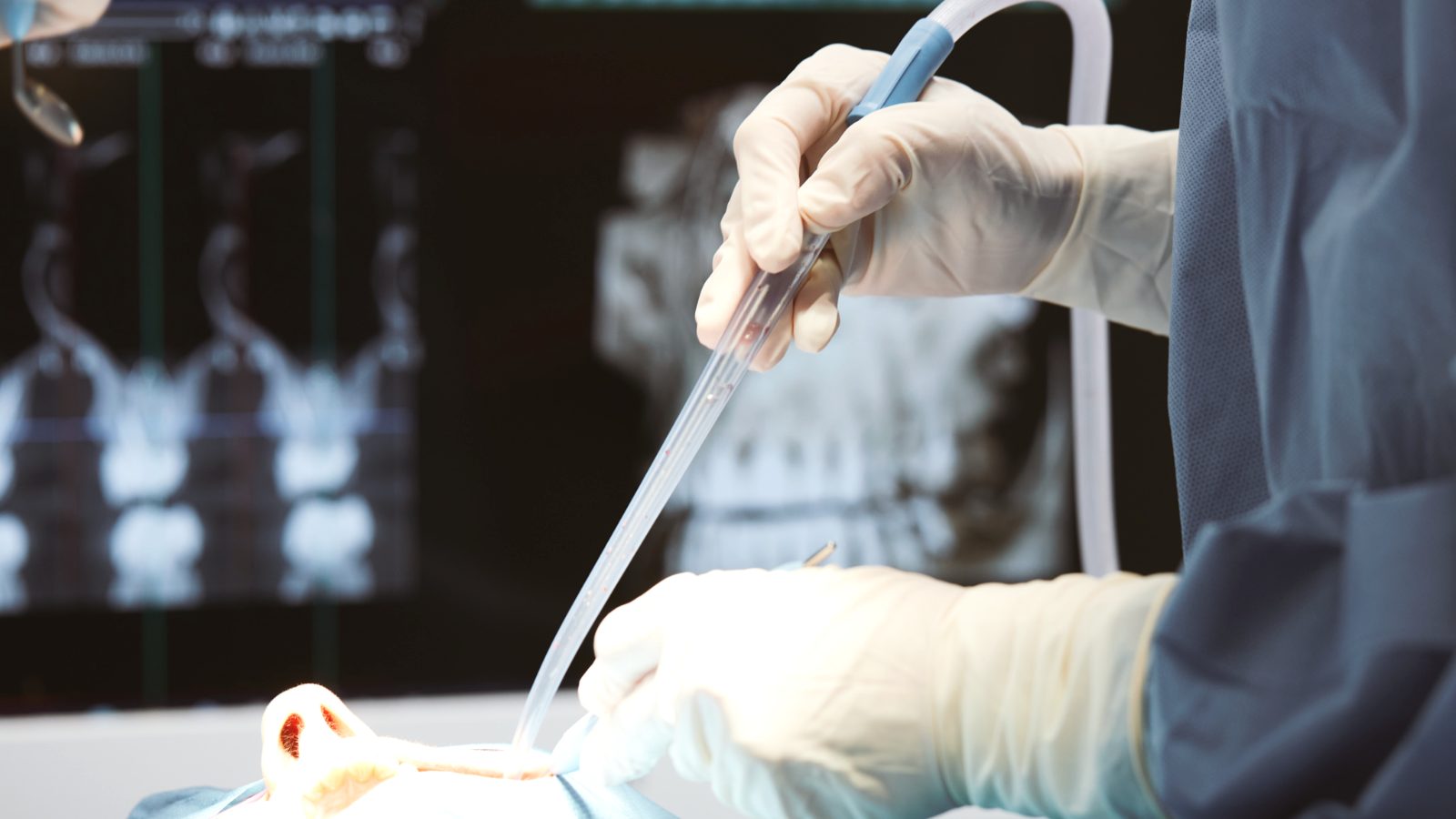 Analyse d'imagerie 3D avant chirurgie d'un kyste des maxillaires