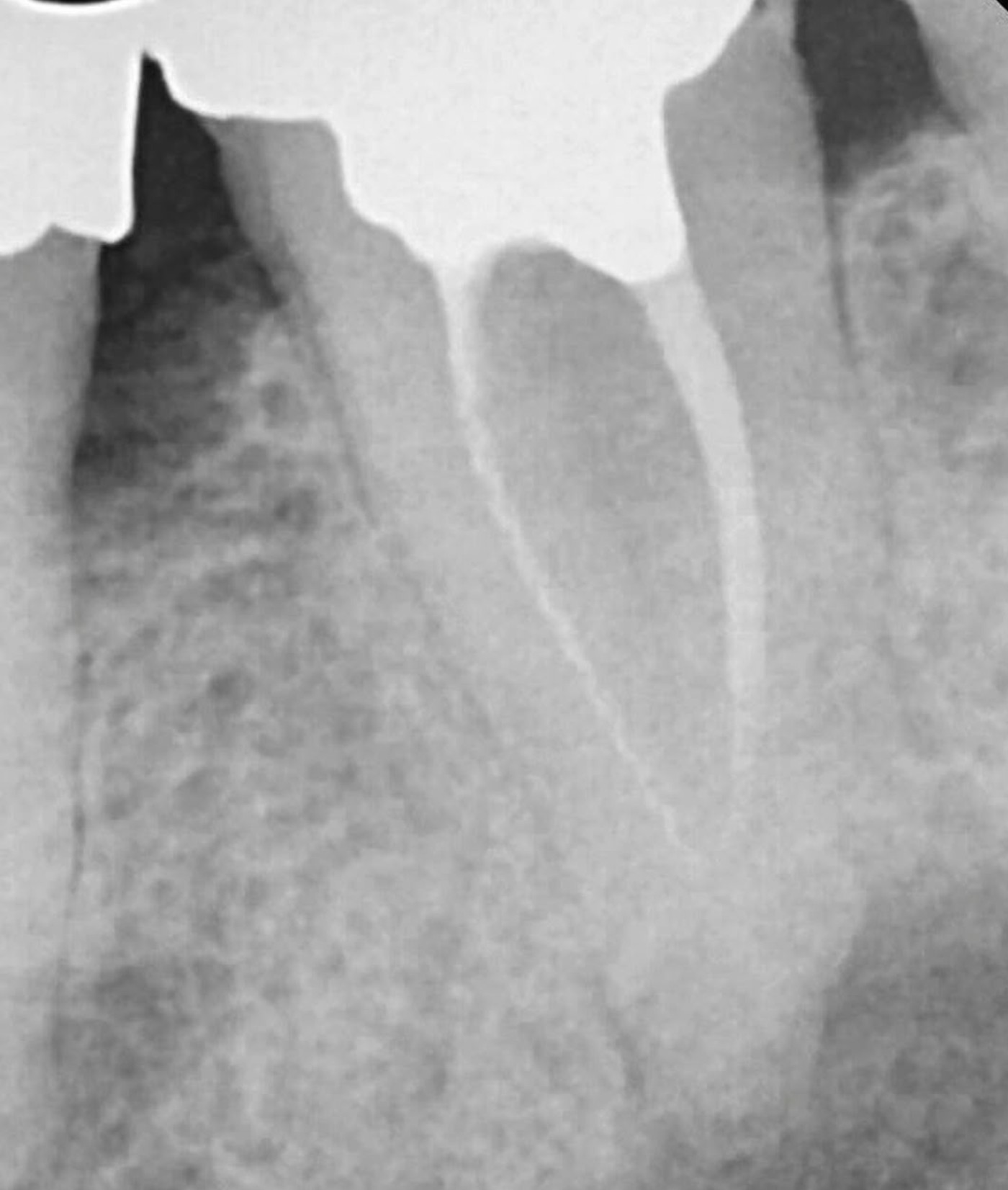 Radiographie rétro-alvéolaire montrant l'anatomie des canaux