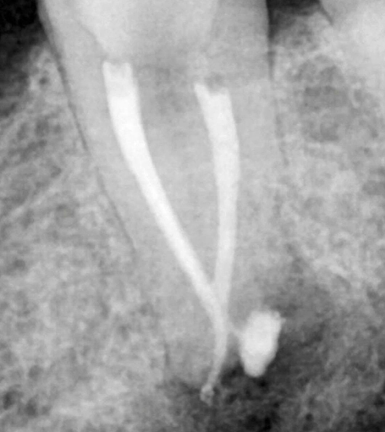Radiographie de contrôle après obturation des canaux