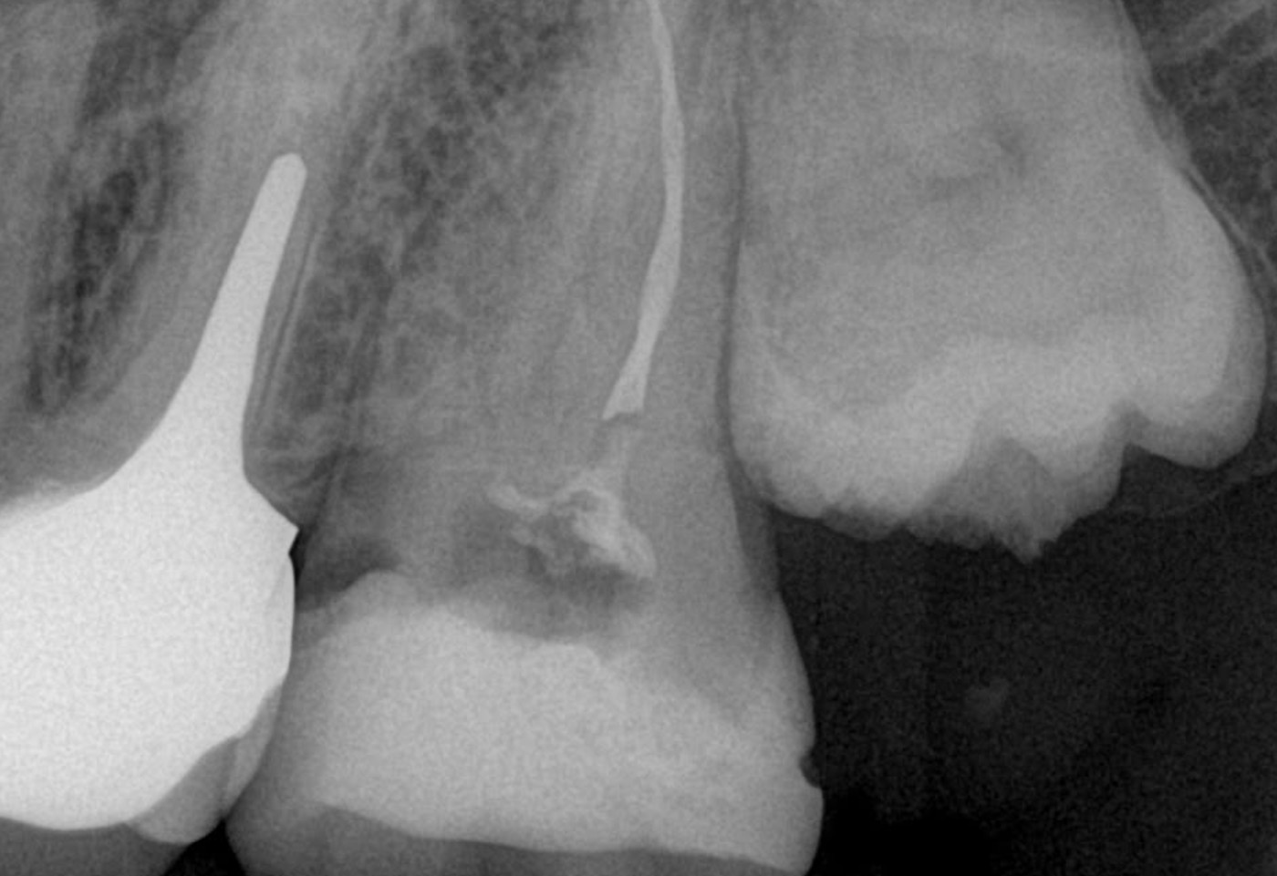 Radiographie d'une dent déjà traitée, avant retraitement