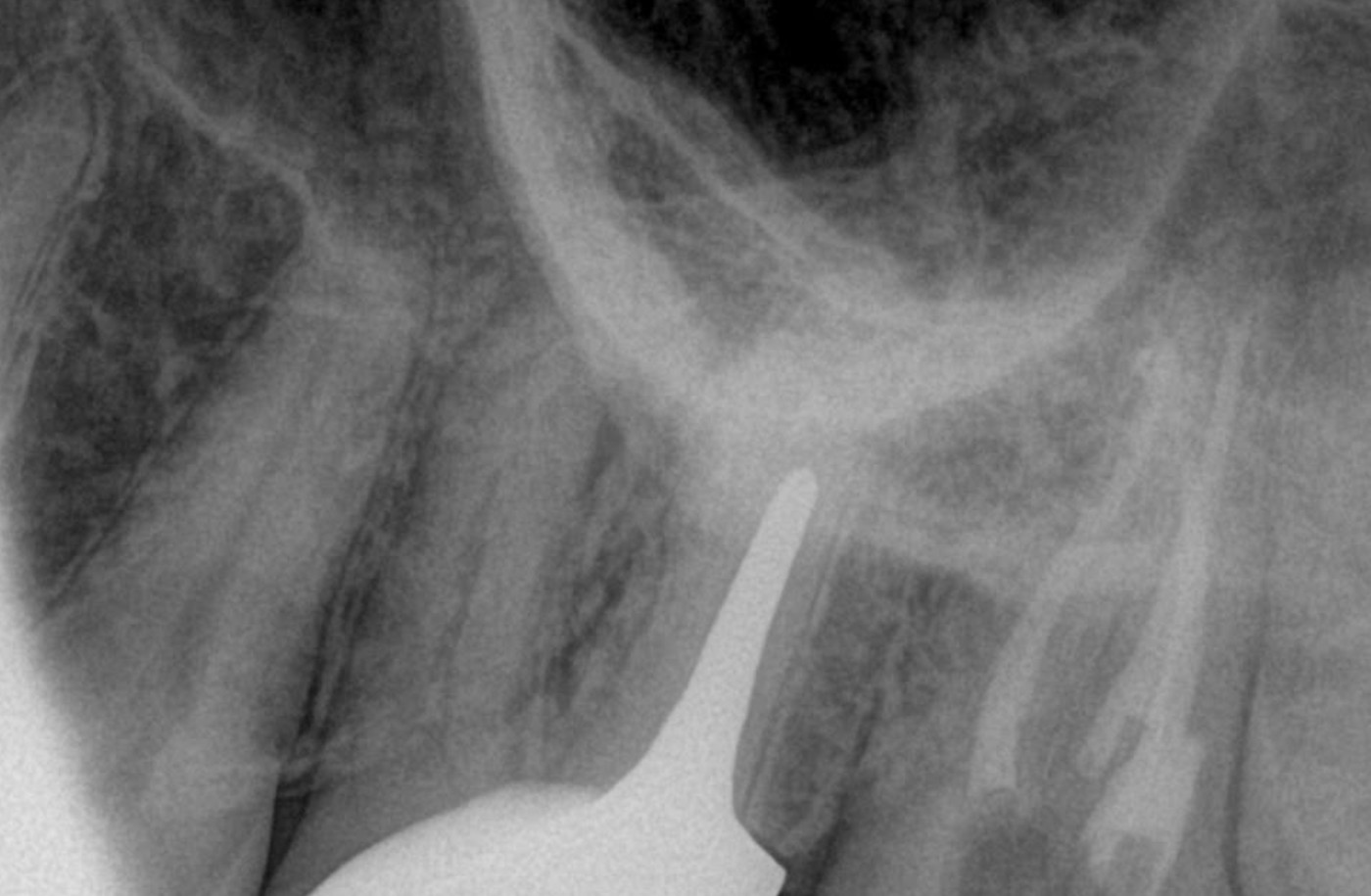 Radiographie rétro-alvéolaire prise au fauteuil pour situer la douleur