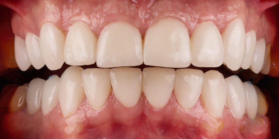 Sourire après restauration des dents antérieures