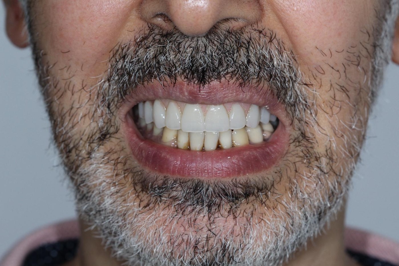 Sourire du patient après la pose du bridge sur implants