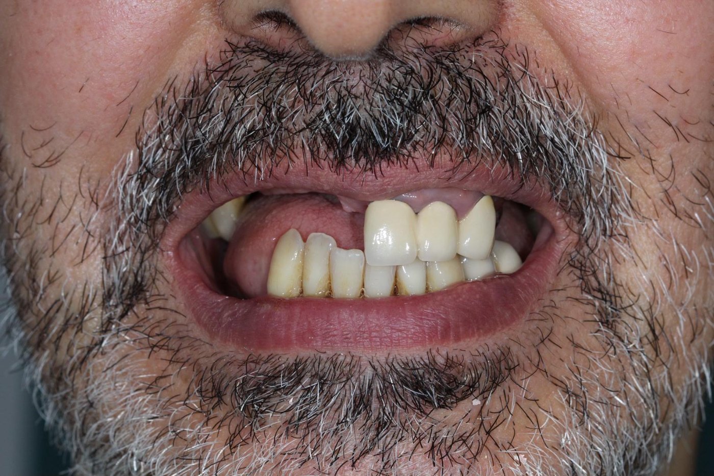 Sourire du patient avant traitement