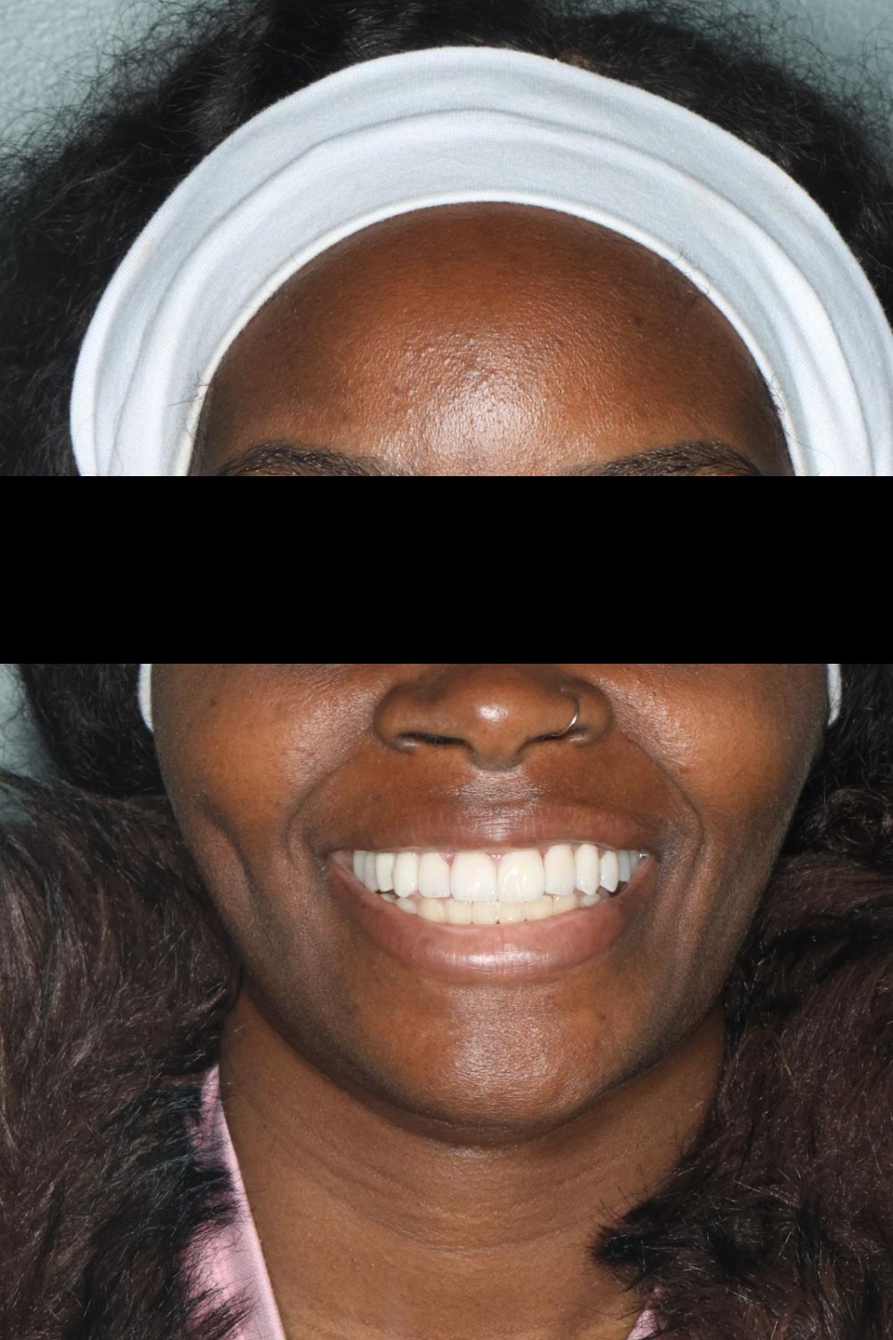 Portrait de la patiente après la pose des facettes, yeux masqués