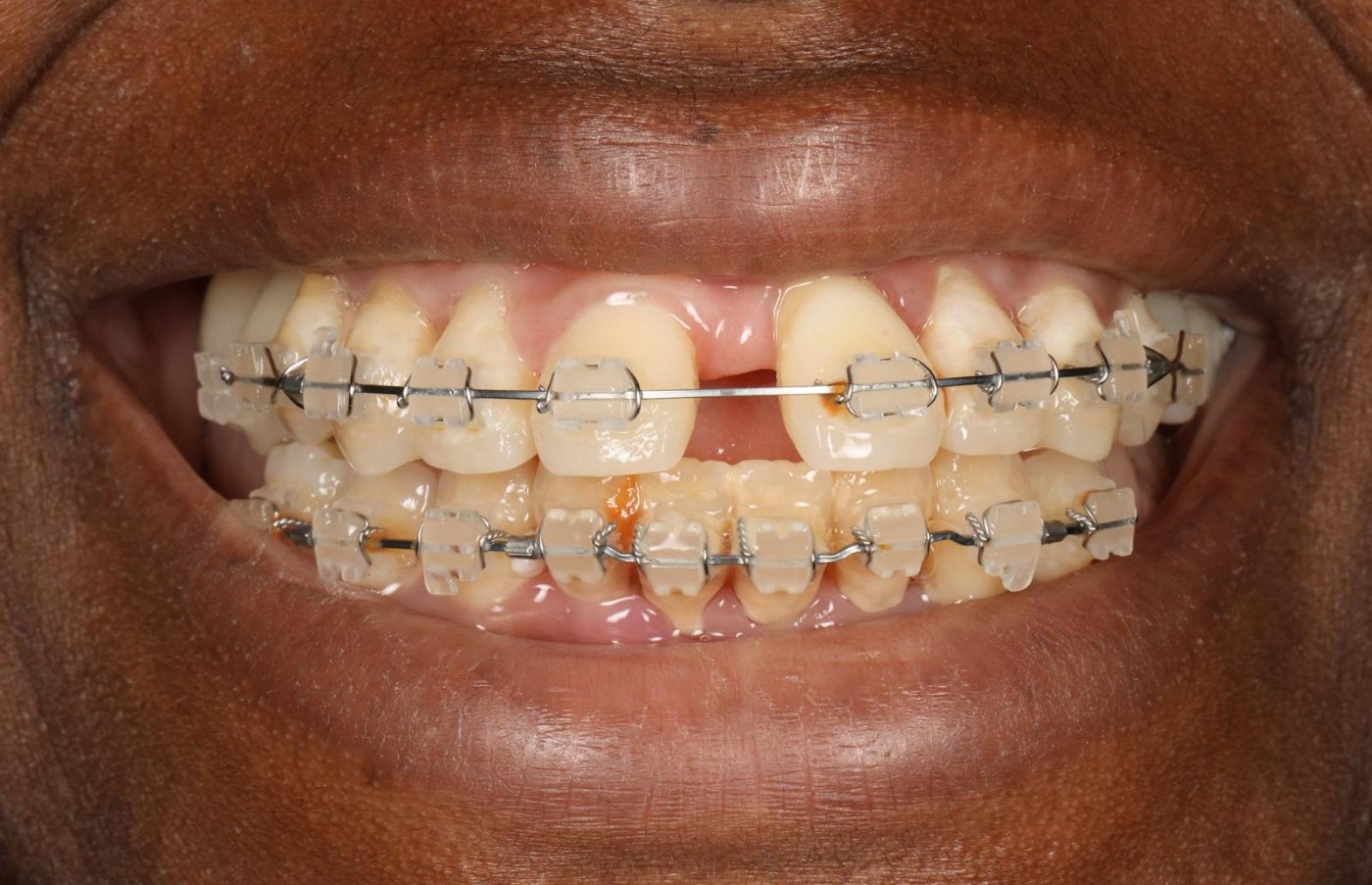 Secteur antérieur avant la pose des facettes, appareil orthodontique en place