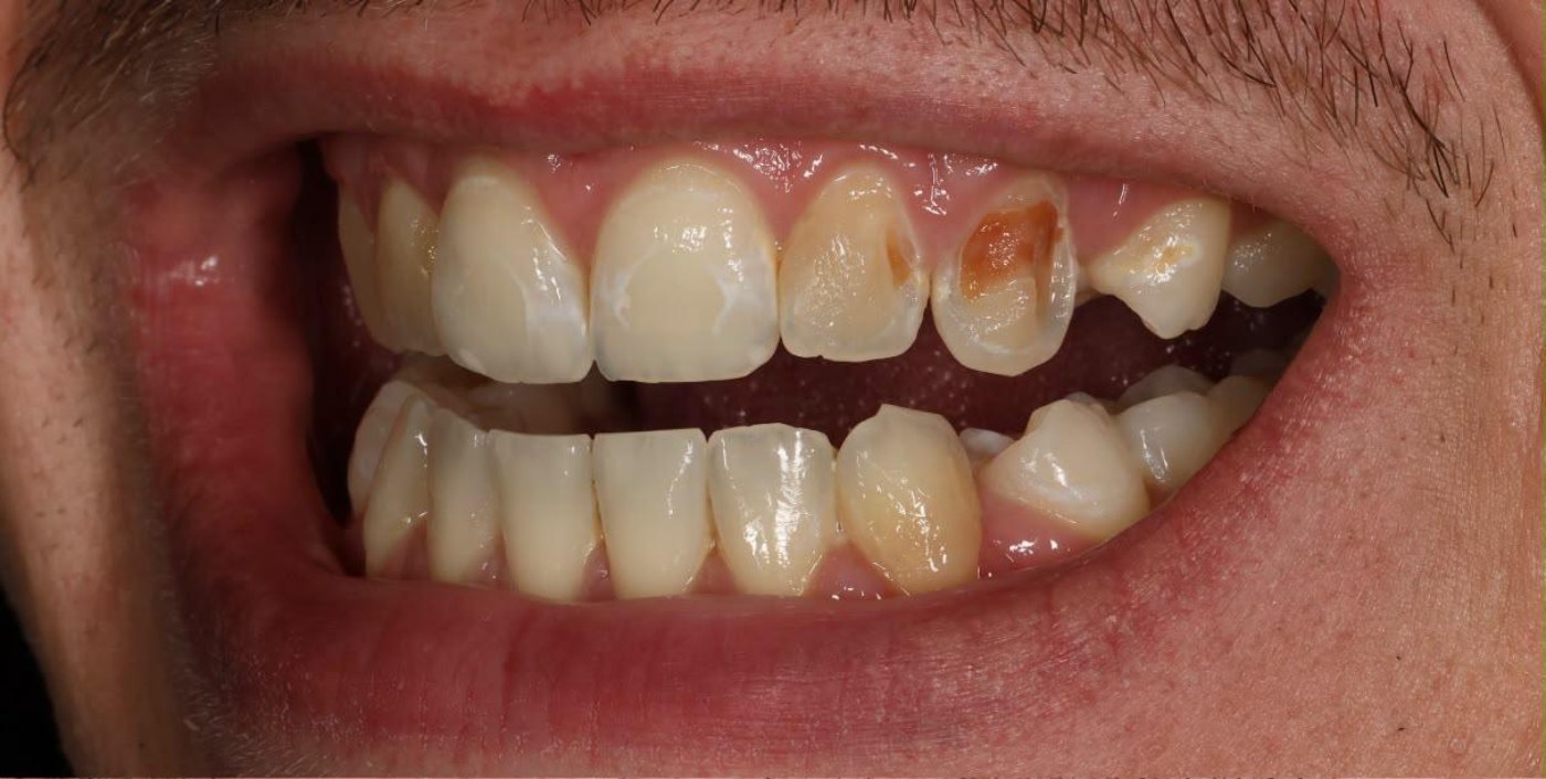 Sourire de face avant la réhabilitation