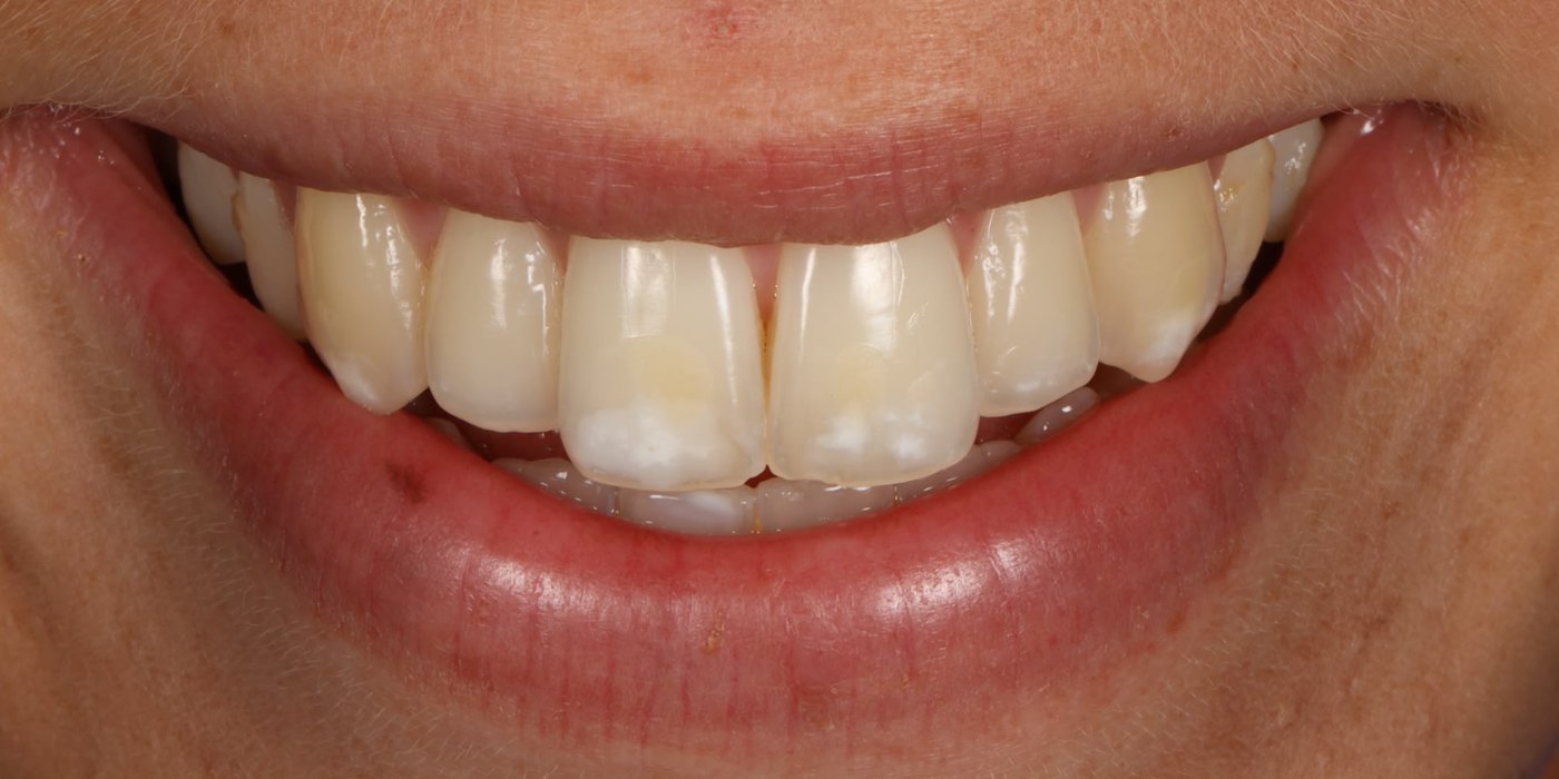 Sourire de la patiente avant traitement, taches blanches sur les incisives