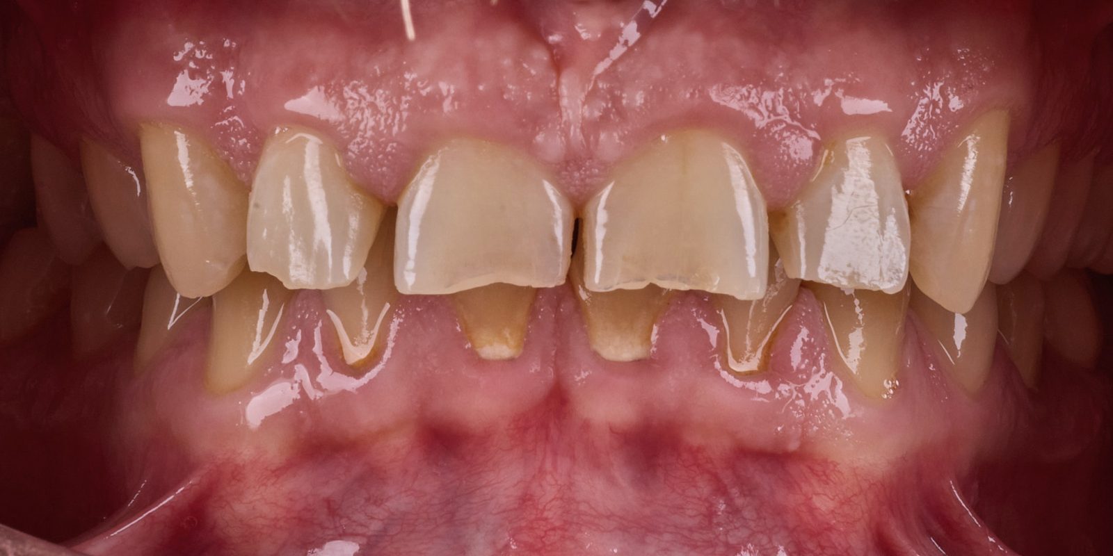 Dents antérieures aux bords usés
