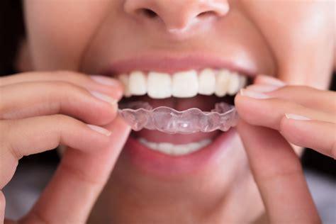 A quoi servent les facettes dentaires ?